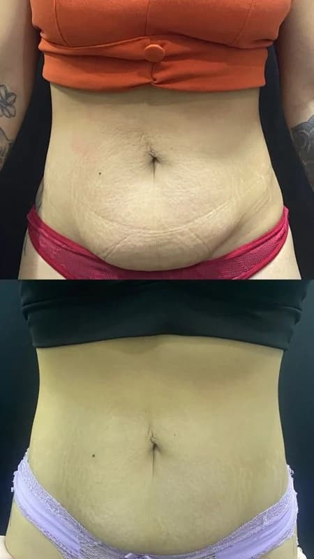 Antes e depois de caso real de StrilRepair — resultado 4