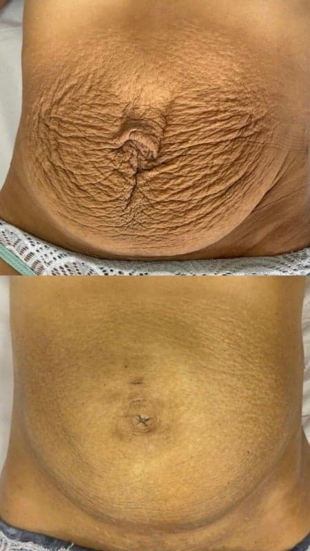 Antes e depois de caso real de FlaciOff — resultado 1