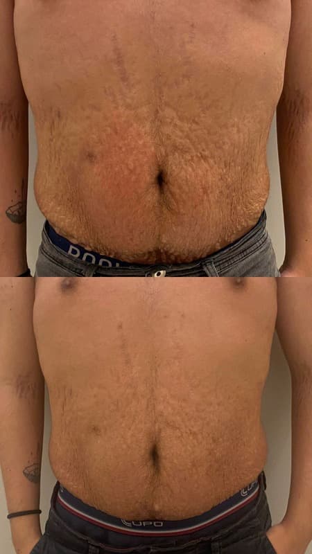 Antes e depois de caso real de FlaciOff — resultado 2