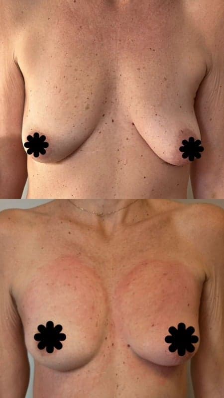 Antes e depois de caso real de FlaciOff — resultado 3