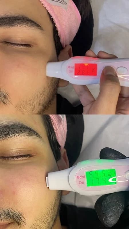 Antes e depois de caso real de Limpeza de Pele — resultado 1