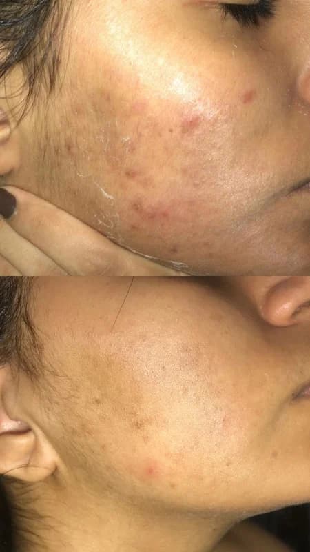 Antes e depois de caso real de Limpeza de Pele — resultado 2