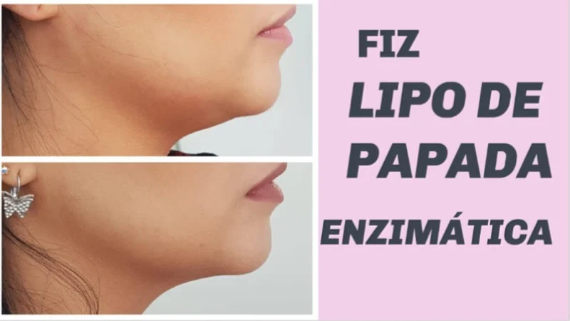 Antes e depois de caso real de Lipo de Papada