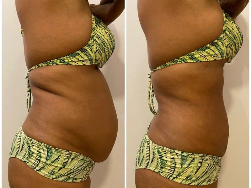 Antes e depois de caso real de Lipoenzimática — resultado 1