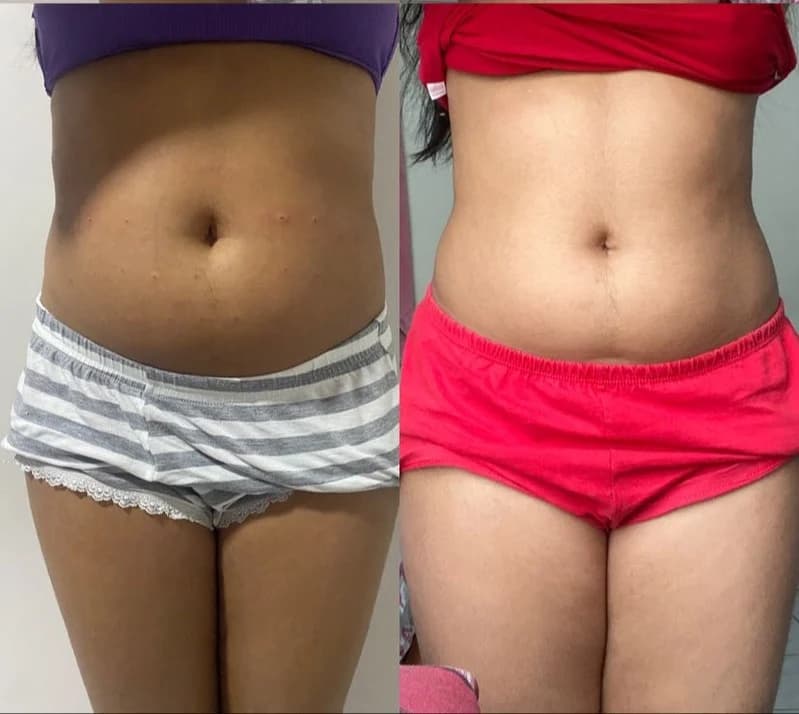 Antes e depois de caso real de Lipoenzimática — resultado 2