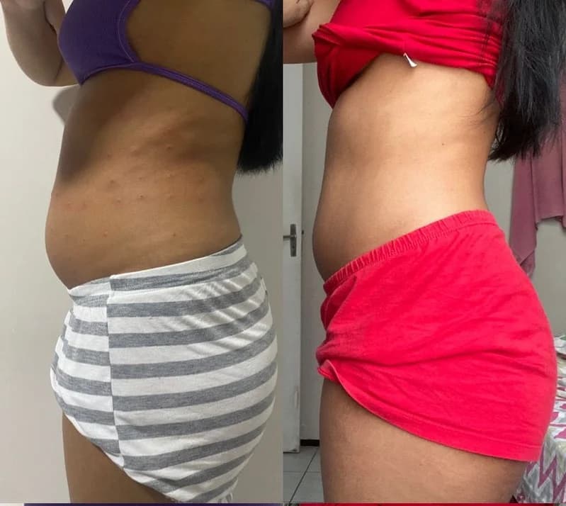 Antes e depois de caso real de Lipoenzimática — resultado 3