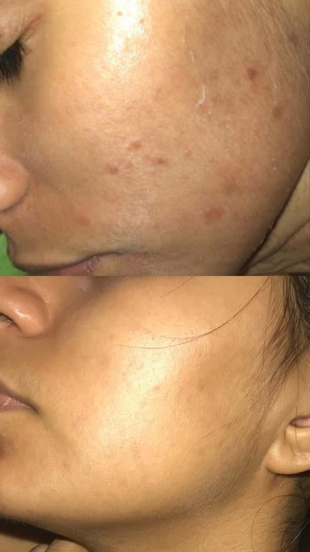 Antes e depois de caso real de Microagulhamento Facial — resultado 1
