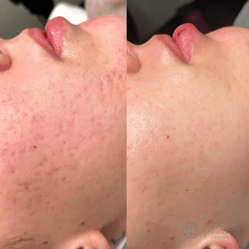 Antes e depois de caso real de Microagulhamento Facial — resultado 2