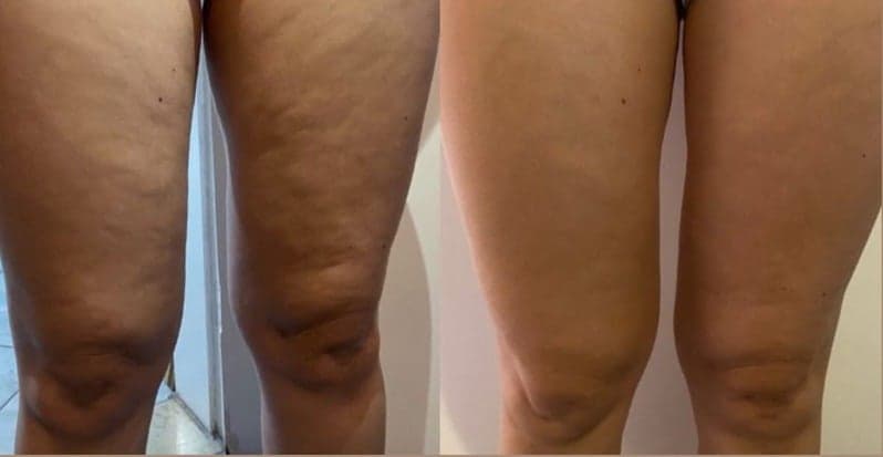 Antes e depois de caso real de Radiofrequência Corporal