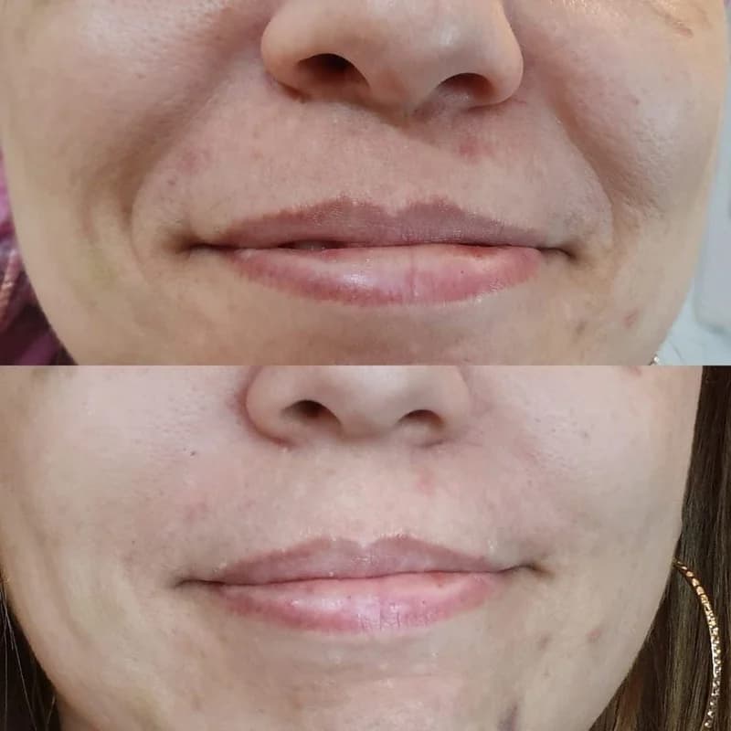Antes e depois de caso real de Radiofrequência Facial
